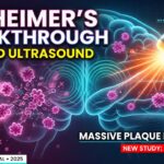 New Alzheimer’s Focused Ultrasound Study Shows Massive Plaque Reduction
